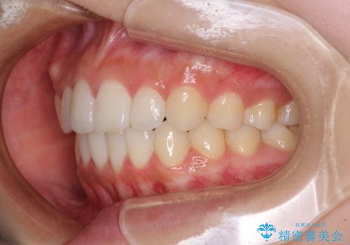 前歯のデコボコと突出感　インビザラインで改善の治療後
