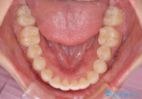 前歯のデコボコと突出感 インビザラインで改善の治療後