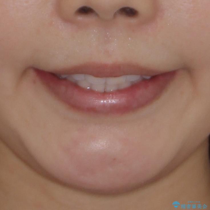 前歯のデコボコと突出感　インビザラインで改善の治療後（顔貌）