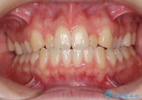 前歯のクロスバイトをインビザライン矯正で改善の症例 治療前