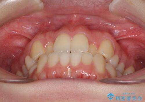 前歯のクロスバイトをインビザライン矯正で改善の治療前