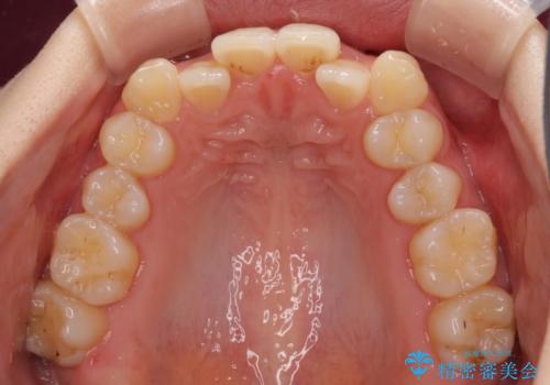 前歯のクロスバイトをインビザライン矯正で改善の治療前