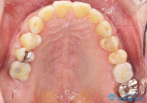 奥歯のインプラント　ソケットリフト　60代男性の治療後