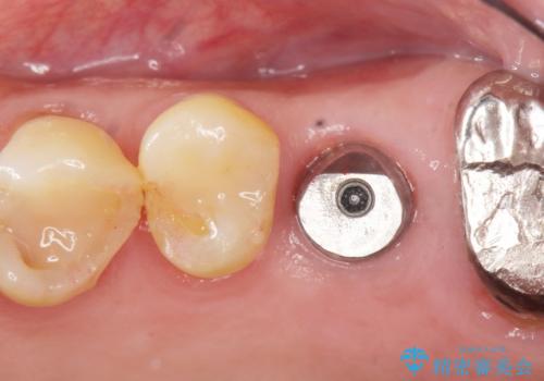 奥歯のインプラント　ソケットリフト　60代男性の治療後