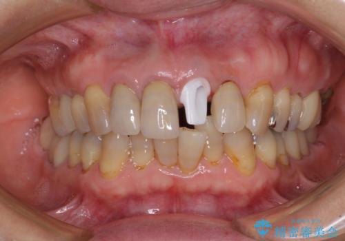 折れてしまった前歯 インプラントによる補綴治療の治療中