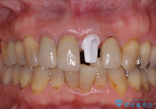 折れてしまった前歯 インプラントによる補綴治療の治療中