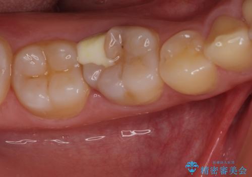神経近くにまで及んだ大きなむし歯のセラミッククラウンの治療前