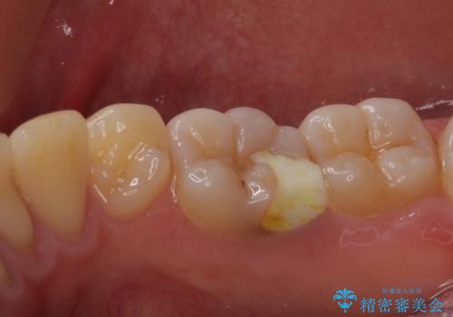 神経近くにまで及んだ大きなむし歯のセラミッククラウンの治療前
