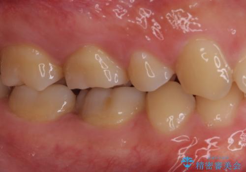 神経近くにまで及んだ大きなむし歯のセラミッククラウンの治療前