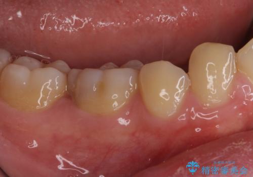 神経近くにまで及んだ大きなむし歯のセラミッククラウンの治療前