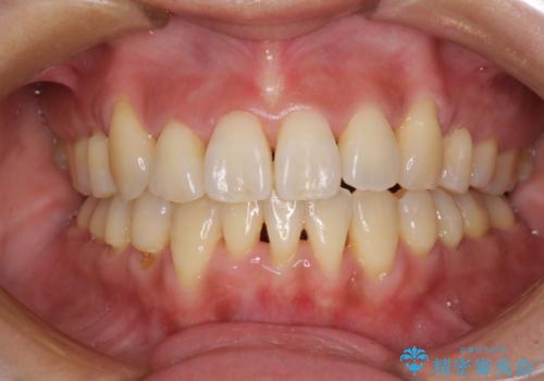 前歯のデコボコを治したい　費用を抑えた抜歯矯正の症例 治療後
