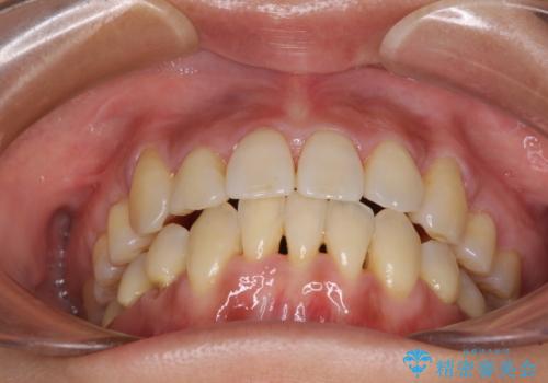 前歯のデコボコを治したい 費用を抑えた抜歯矯正の治療後