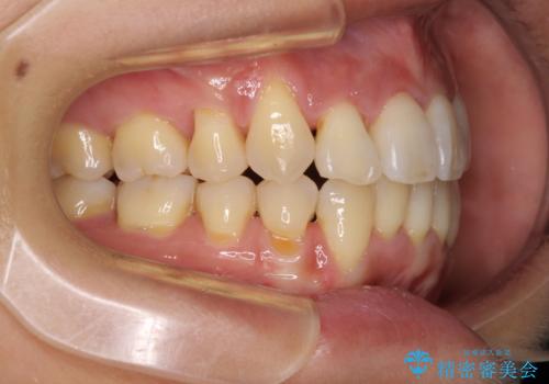 前歯のデコボコを治したい 費用を抑えた抜歯矯正の治療後