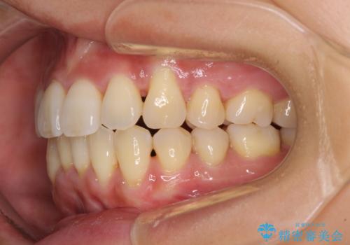 前歯のデコボコを治したい 費用を抑えた抜歯矯正の治療後