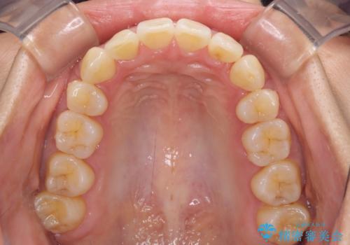 前歯のデコボコを治したい 費用を抑えた抜歯矯正の治療後