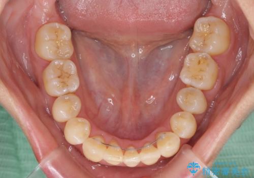 前歯のデコボコを治したい 費用を抑えた抜歯矯正の治療後