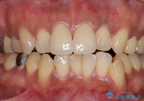 度重なる治療で前歯がしみる　オールセラミッククラウンによる補綴治療の治療後