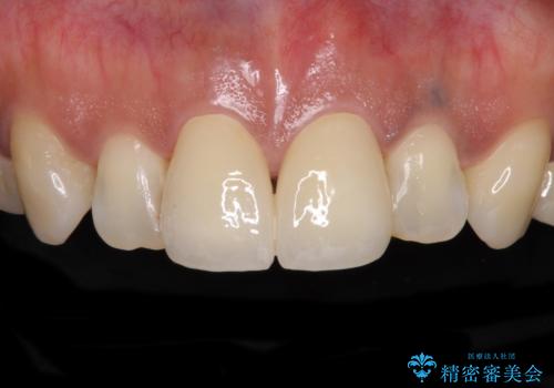 度重なる治療で前歯がしみる　オールセラミッククラウンによる補綴治療
