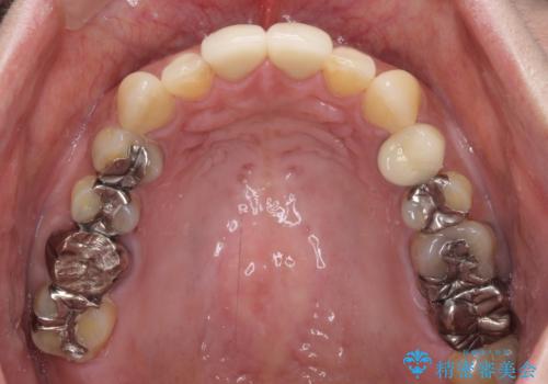 度重なる治療で前歯がしみる　オールセラミッククラウンによる補綴治療の治療後