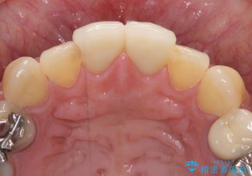 度重なる治療で前歯がしみる オールセラミッククラウンによる補綴治療の治療後