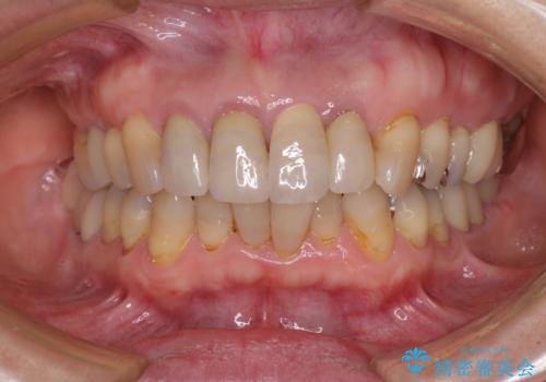折れてしまった前歯 インプラントによる補綴治療の治療後