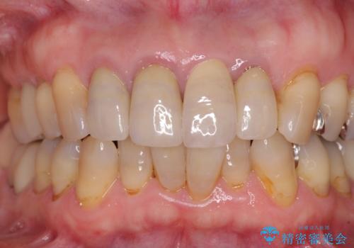 折れてしまった前歯 インプラントによる補綴治療の治療後