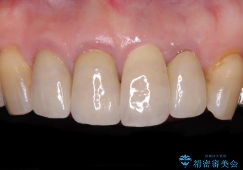 折れてしまった前歯 インプラントによる補綴治療の症例 治療後