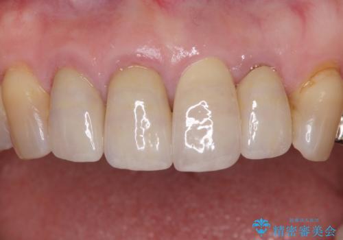 折れてしまった前歯 インプラントによる補綴治療の治療後
