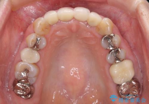 折れてしまった前歯 インプラントによる補綴治療の治療後