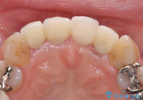 折れてしまった前歯 インプラントによる補綴治療の治療後
