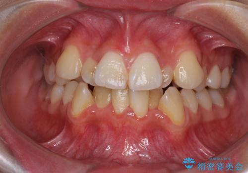 どんなに磨いても汚れが溜まる　抜歯矯正で清潔な口元にの症例 治療前