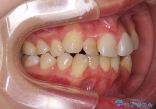 どんなに磨いても汚れが溜まる　抜歯矯正で清潔な口元にの治療前