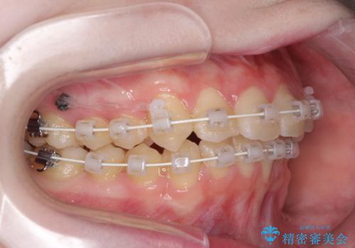 前歯をきれいに整えたい　ワイヤー装置での非抜歯矯正の治療中