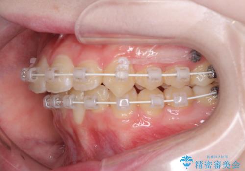 前歯をきれいに整えたい ワイヤー装置での非抜歯矯正の治療中