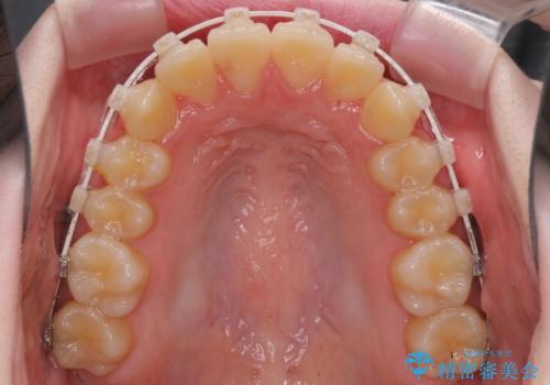 前歯をきれいに整えたい ワイヤー装置での非抜歯矯正の治療中