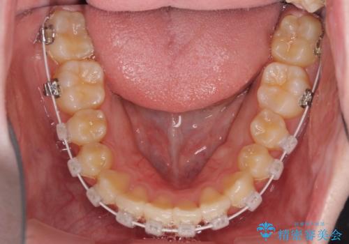 前歯をきれいに整えたい ワイヤー装置での非抜歯矯正の治療中