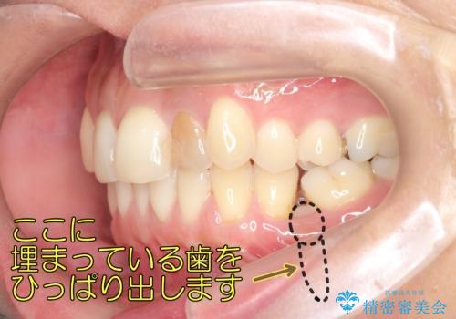 埋まっている奥歯を引っ張り出す インビザライン矯正