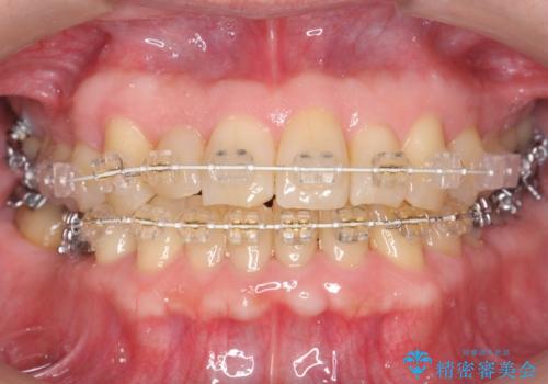 50代男性 受け口 他院で5年以上かかると治療を断られたの治療中