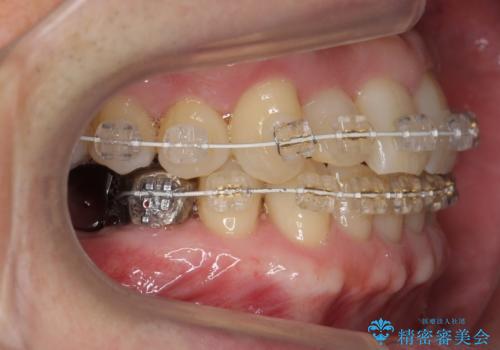 50代男性 受け口 他院で5年以上かかると治療を断られたの治療中