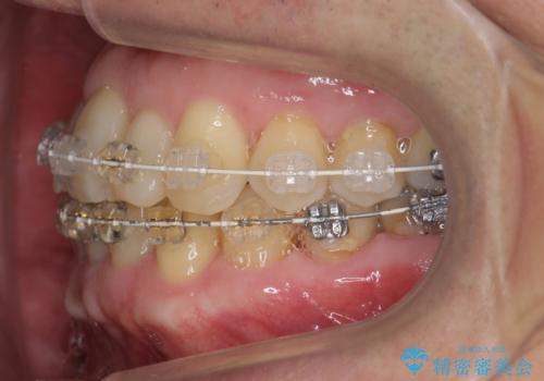 50代男性 受け口 他院で5年以上かかると治療を断られたの治療中