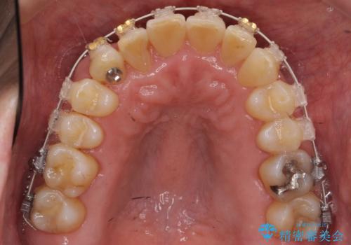 50代男性 受け口 他院で5年以上かかると治療を断られたの治療中
