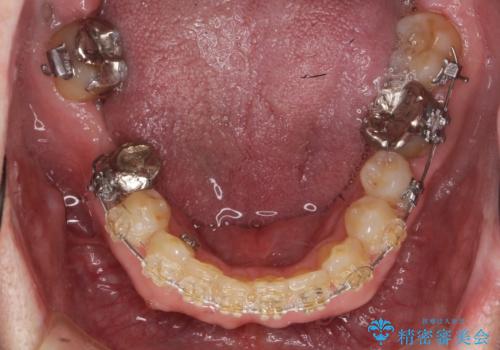 50代男性 受け口 他院で5年以上かかると治療を断られたの治療中