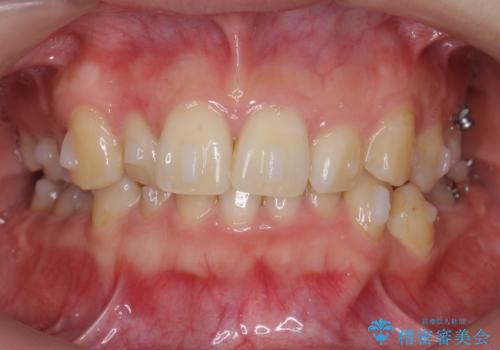 歯並びのがたつきを直したい ワイヤーは嫌 抜きたくないの治療中
