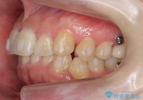 歯並びのがたつきを直したい ワイヤーは嫌 抜きたくないの治療中