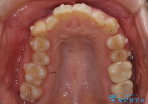 歯並びのがたつきを直したい ワイヤーは嫌 抜きたくないの治療中