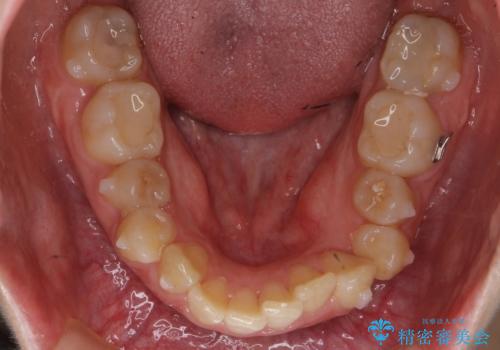 歯並びのがたつきを直したい ワイヤーは嫌 抜きたくないの治療中