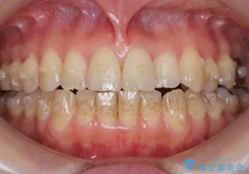 前歯のガタガタ 治療期間がかかっても良いので非抜歯でマウスピースでの治療中