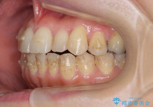 前歯のガタガタ 治療期間がかかっても良いので非抜歯でマウスピースでの治療中