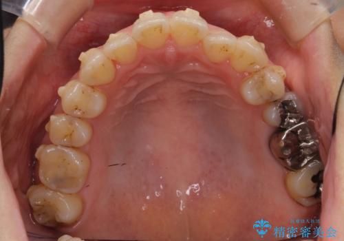 前歯のガタガタ　治療期間がかかっても良いので非抜歯でマウスピースでの治療中