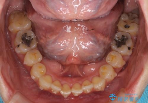 前歯のガタガタ 治療期間がかかっても良いので非抜歯でマウスピースでの治療中